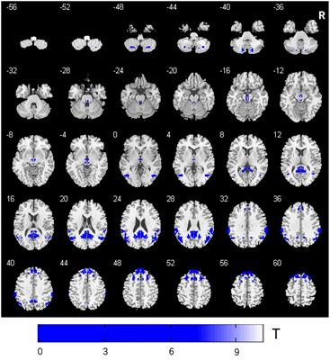 Altered Interhemispheric Functional Connectivity Associated With Early Verbal Fluency Decline After Deep Brain Stimulation in Parkinson’s Disease